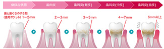 歯周病症状の段階